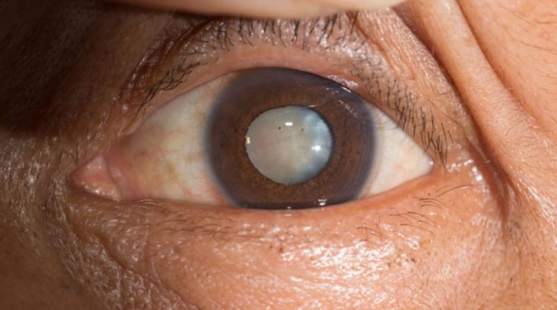 Cataracts can be dissolved by an eye drop that scientists have made