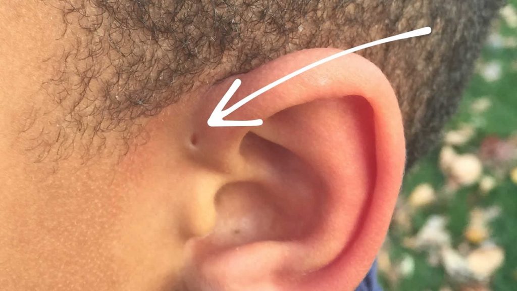 Extra ear hole