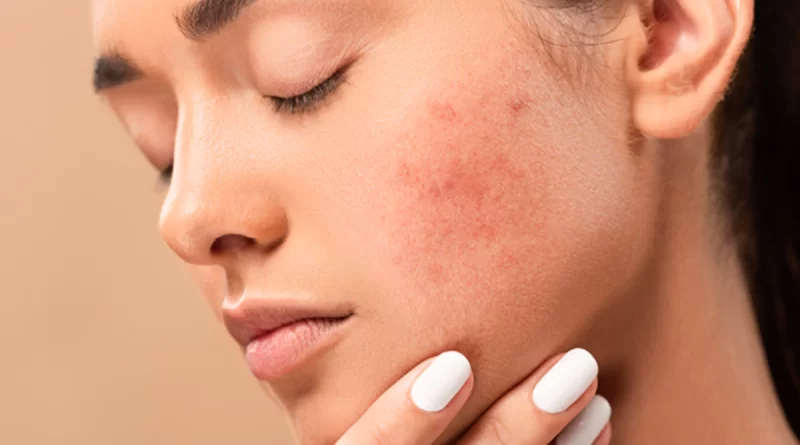Researchers may have found out why bacteria only gives some people acne
