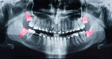 There is mounting evidence that routine wisdom tooth removal is a waste of time