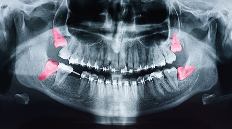 There is mounting evidence that routine wisdom tooth removal is a waste of time